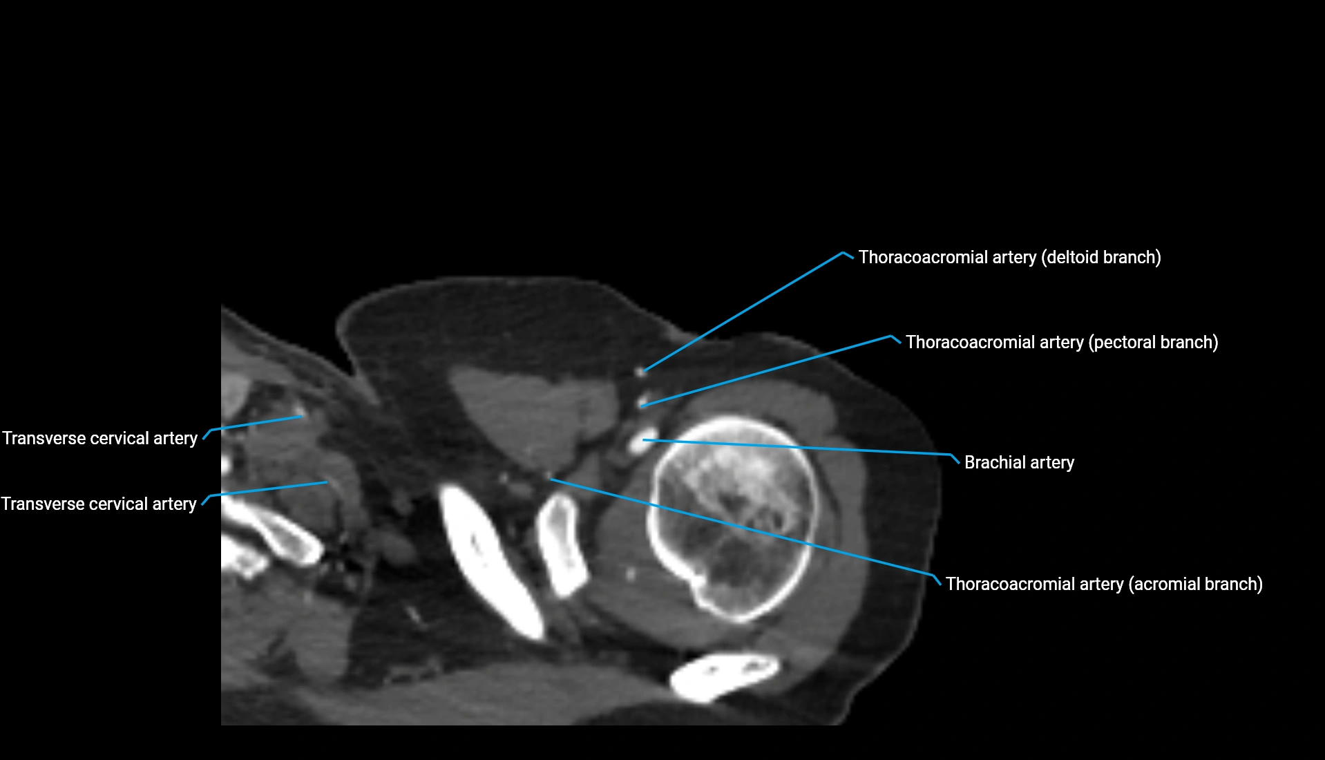 CTA upper limb axial cross sectional anatomy labelled image 324 (1).webp